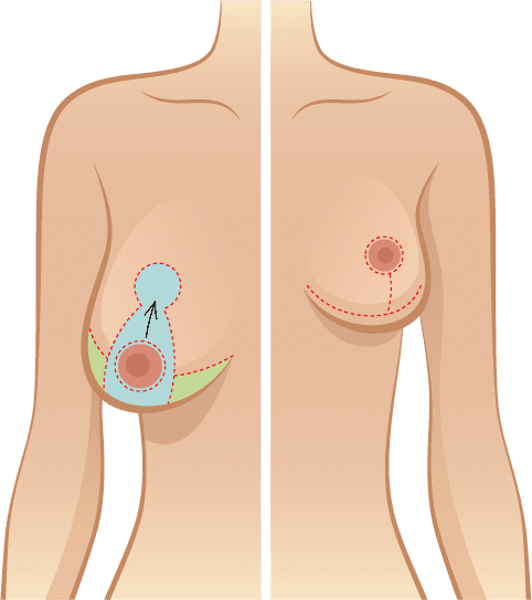 Brustreduktion Dr. Adamskaya, Plastische und Ästhetische Chirurgie
