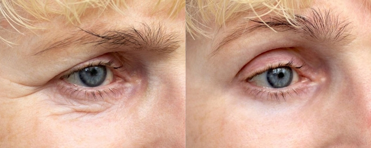Eyelid Lift 5 Dr. Adamskaya Plastische und Ästhetische Chirurgie Wien