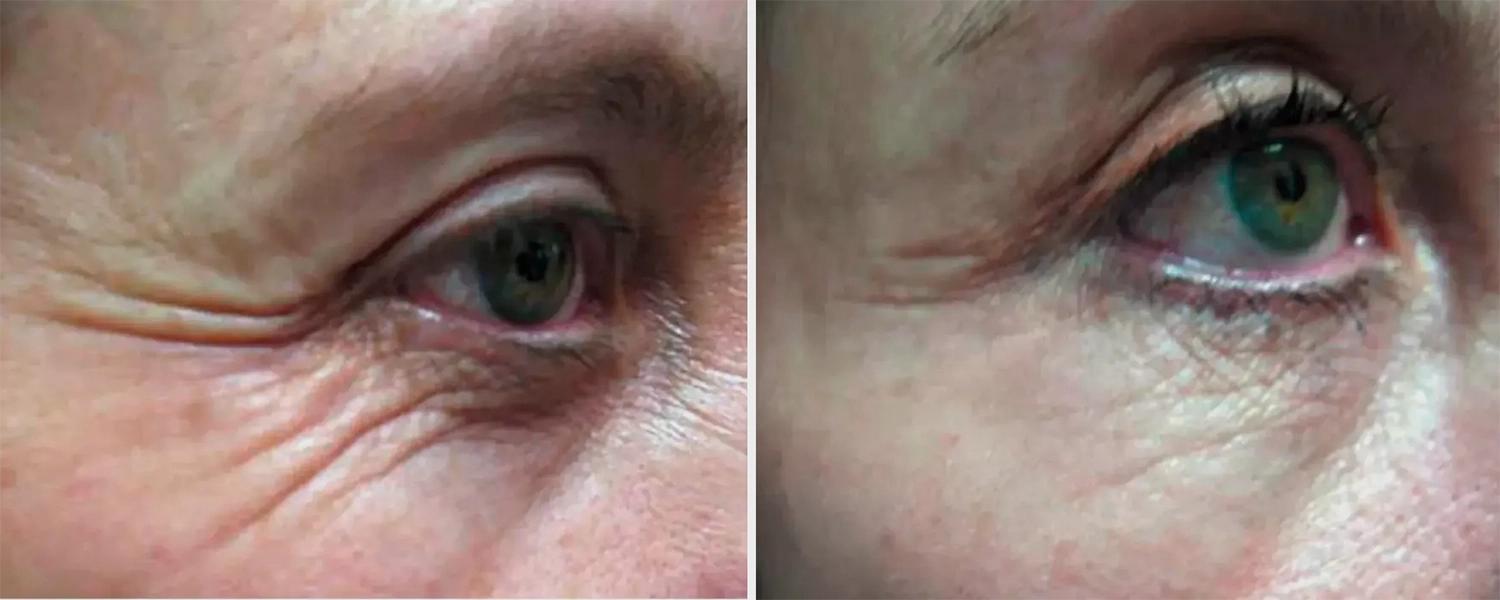 Eyelid Lift A Dr. Adamskaya Plastische und Ästhetische Chirurgie Wien