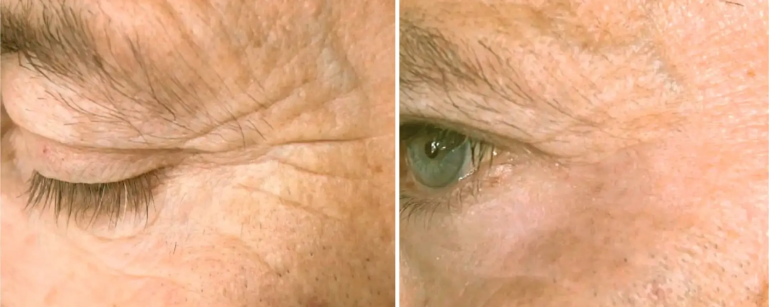 Eyelid Lift B Dr. Adamskaya Plastische und Ästhetische Chirurgie Wien