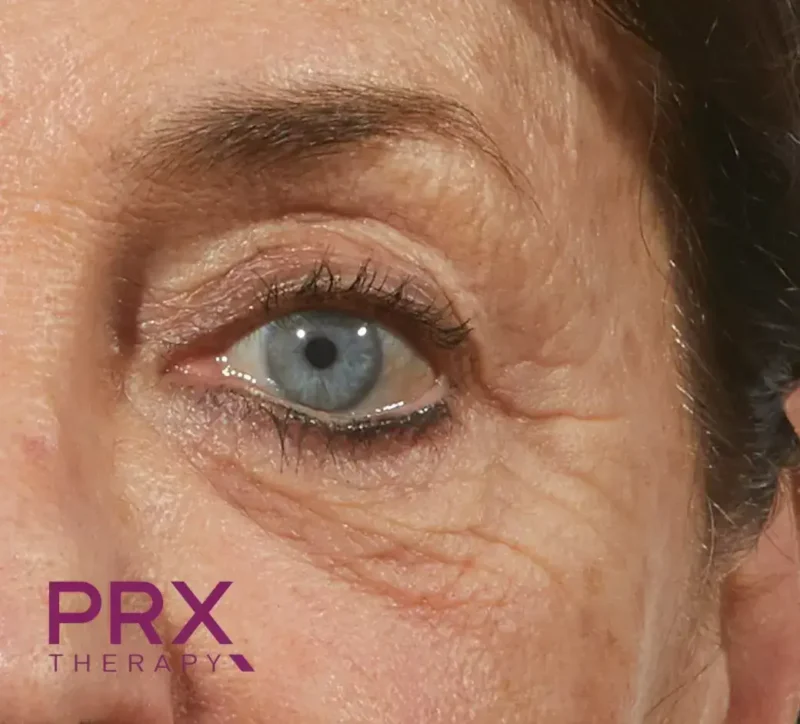 PRX Augen A Nachher Dr. Adamskaya Plastische und Ästhetische Chirurgie