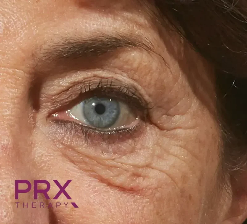 PRX Augen A Vorher Dr. Adamskaya Plastische und Ästhetische Chirurgie