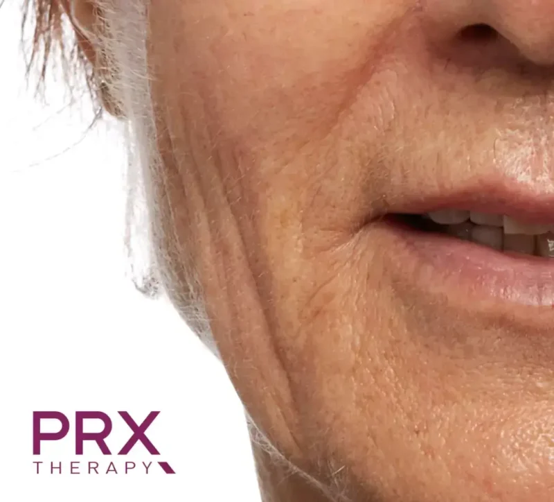 PRX Gesichtskontur Vorher Dr. Adamskaya Plastische und Ästhetische Chirurgie