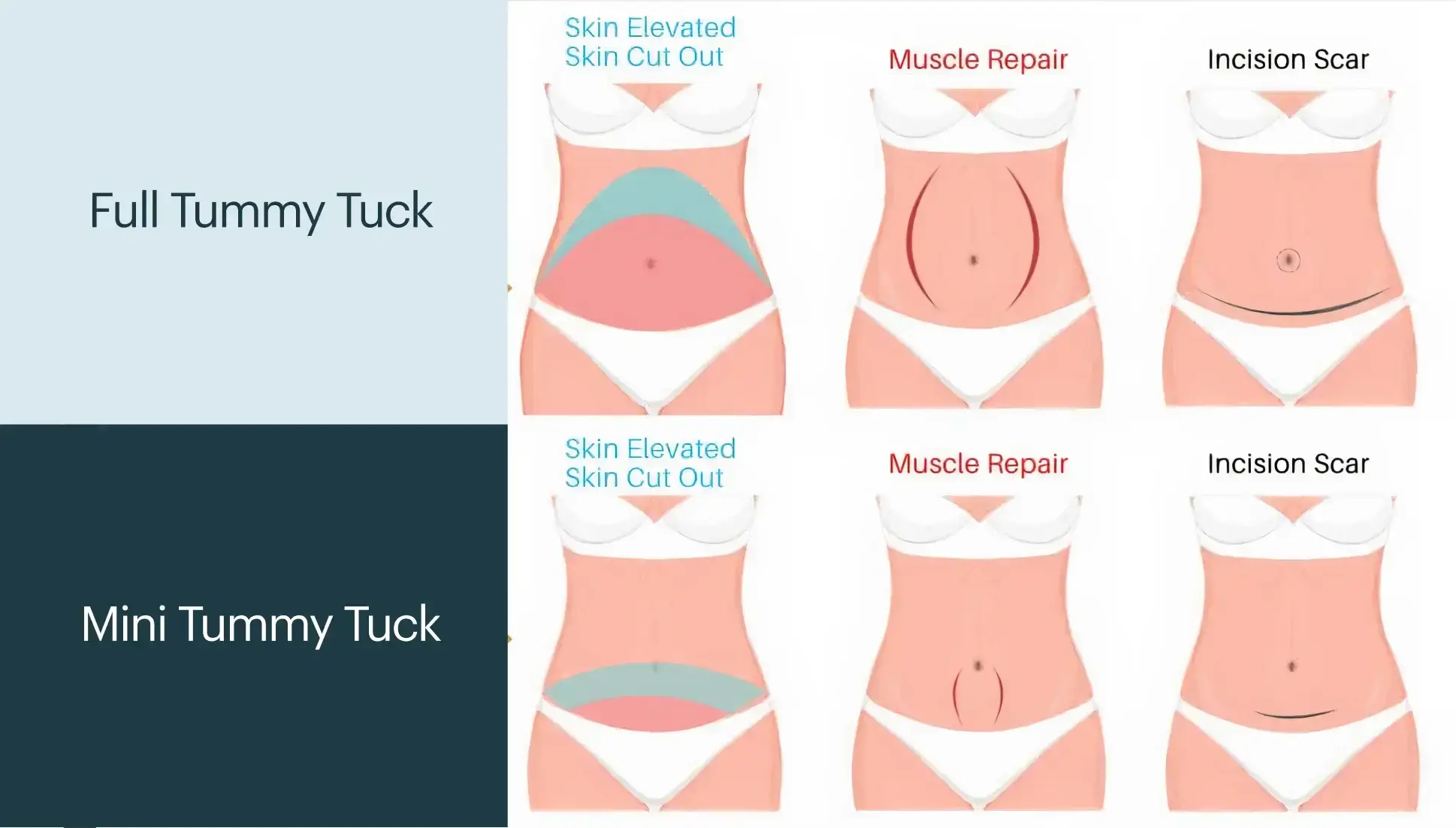 Tummy Tuck Dr. Adamskaya Plastische und Ästhetische Chirurgie