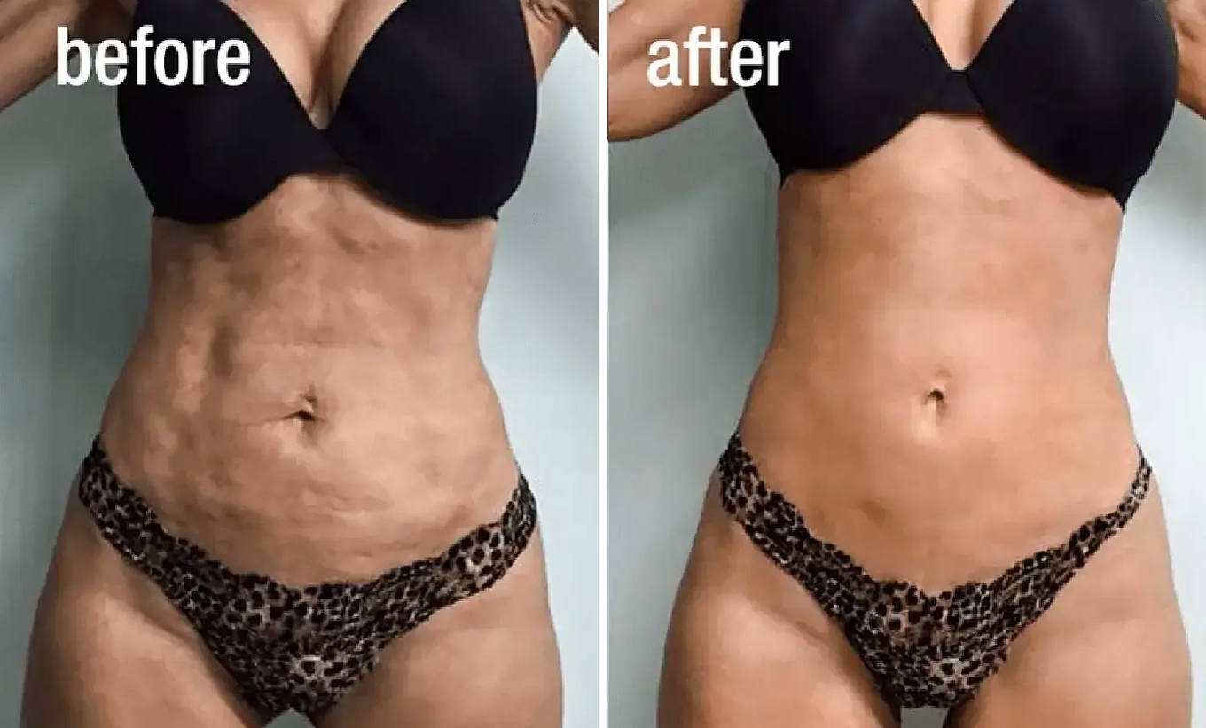 Körperformung Dr. Adamskaya Plastische und Ästhetische Chirurgie Wien B