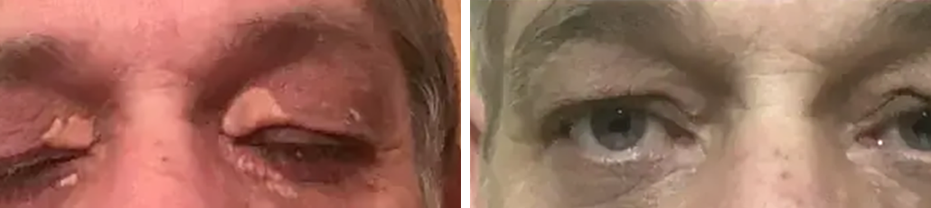 Xanthelasmen Dr. Adamskaya Plastische und Ästhetische Chirurgie Wien B