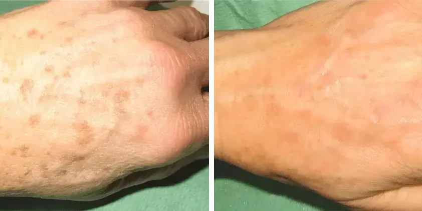 Altersflecken_Sonnenschden Dr. Adamskaya Plastische und Ästhetische Chirurgie Wien Vorher Nachher