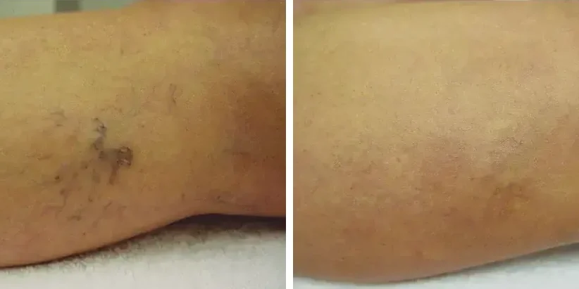 Besenreiser Vorher Nachher Dr. Adamskaya Plastische und Ästhetische Chirurgie Wien