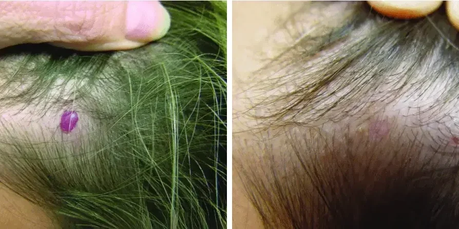 Blutschwämmchen Vorher Nachher Dr. Adamskaya Plastische und Ästhetische Chirurgie Wien