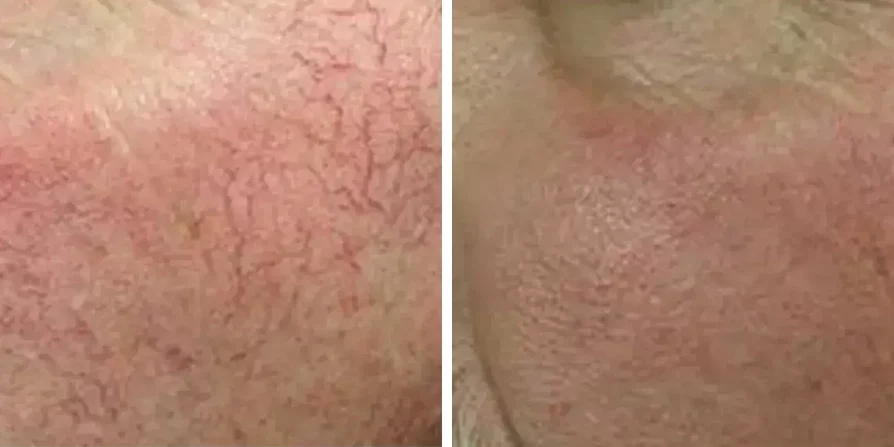 Couperose Vorher Nachher Dr. Adamskaya Plastische und Ästhetische Chirurgie Wien